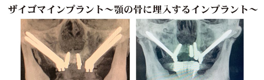ザイゴマインプラント　顎の骨に埋入するインプラント